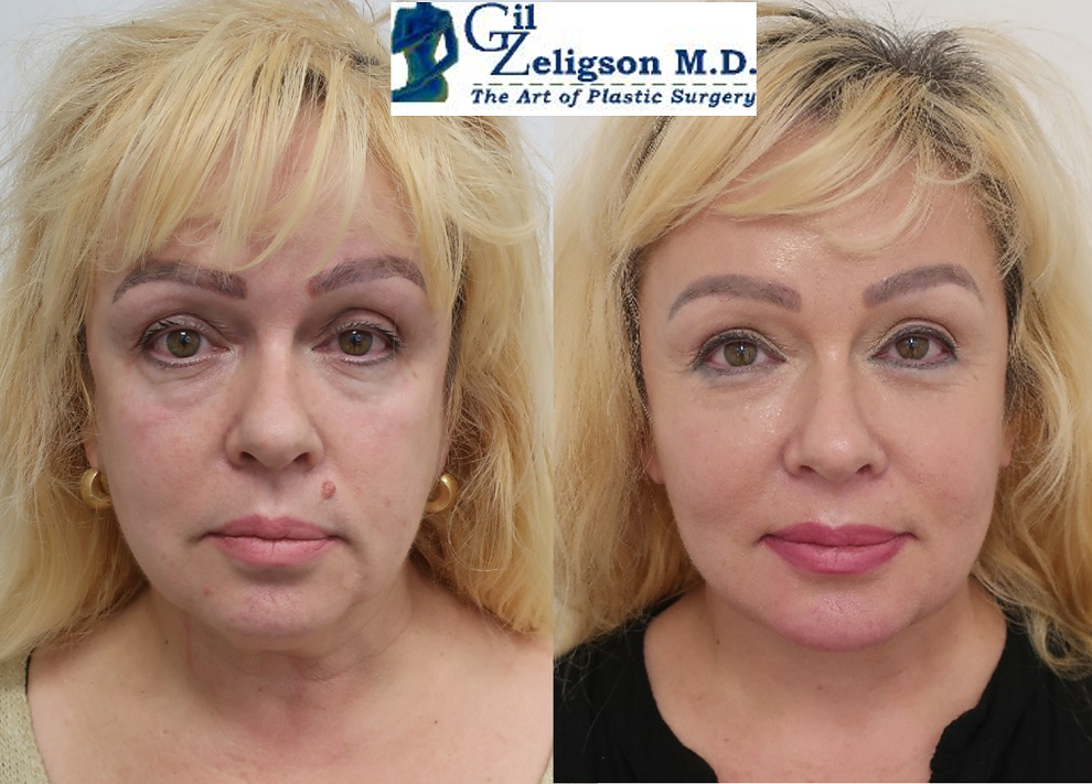 Dr. Gil Zeligson - Facial Sculpturing Hyaluronic acid
