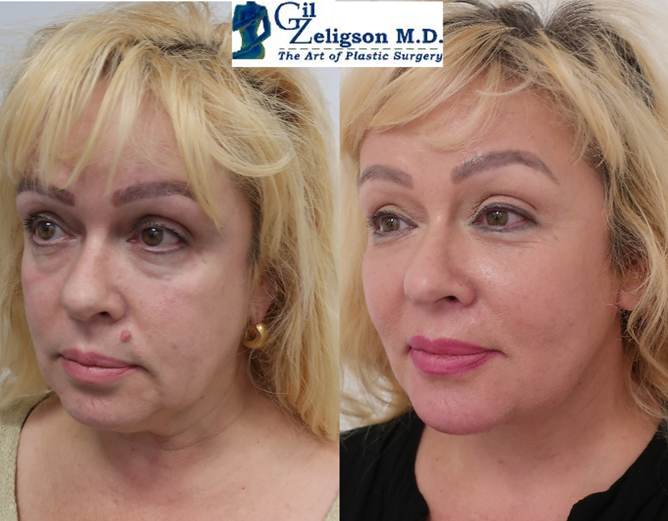 Dr. Gil Zeligson - Facial Sculpturing Hyaluronic acid