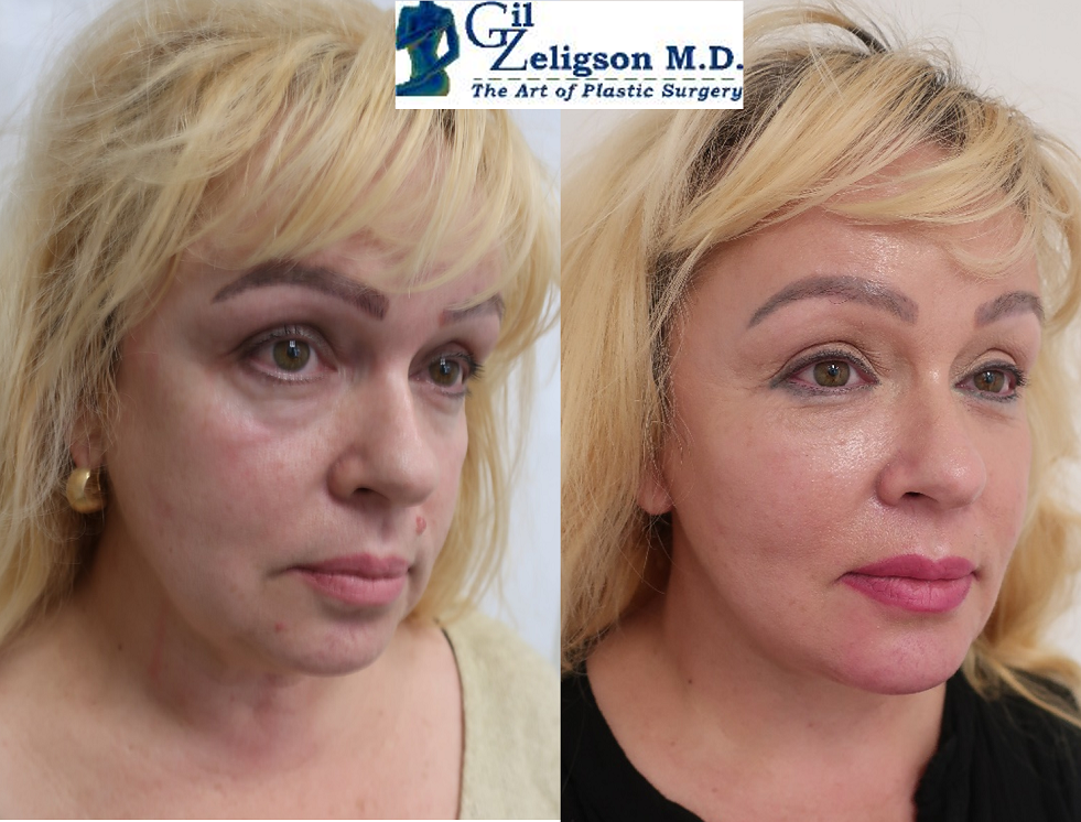 Dr. Gil Zeligson - Facial Sculpturing Hyaluronic acid
