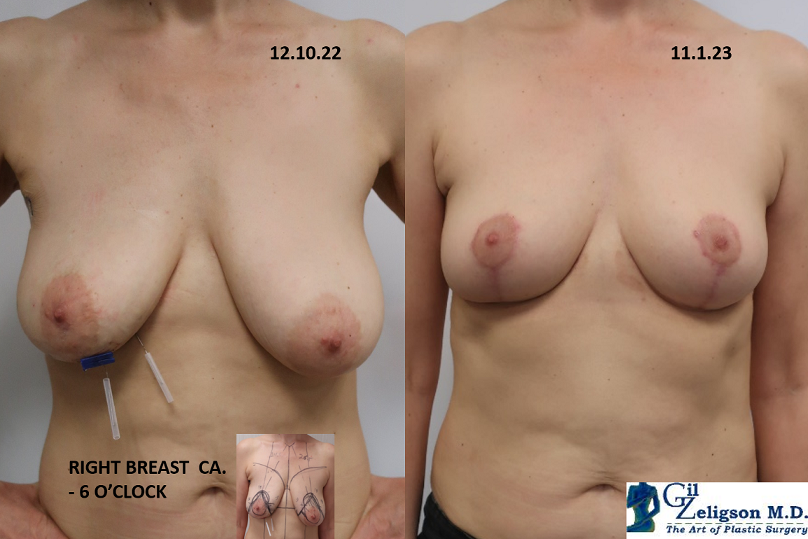 Dr. Gil Zeligson - Breast Reduction