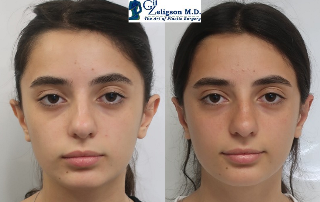 Dr. Gil Zeligson - Otoplasty