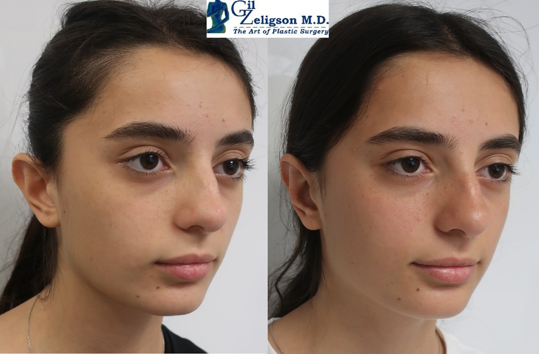 Dr. Gil Zeligson - Otoplasty