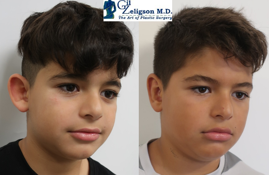 Dr. Gil Zeligson - Otoplasty