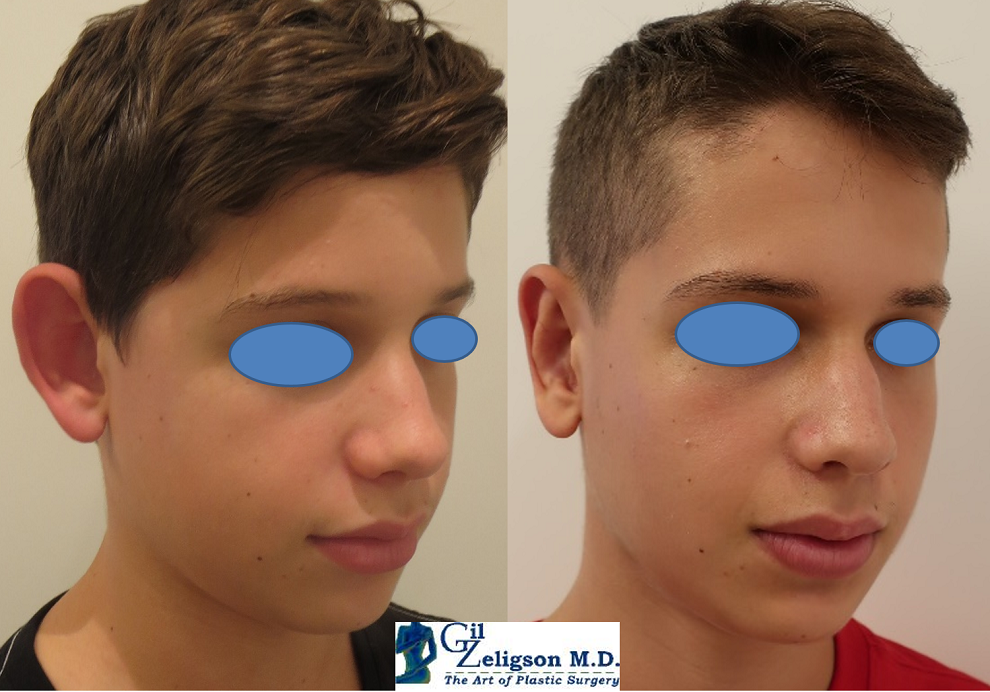 Dr. Gil Zeligson - Otoplasty