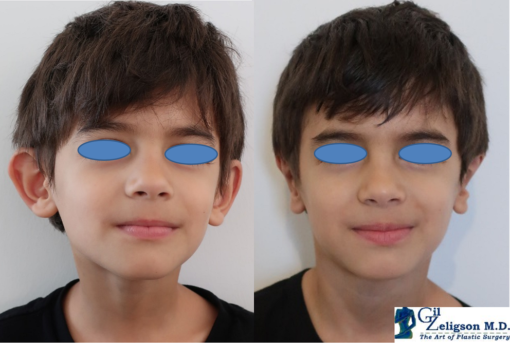 Dr. Gil Zeligson - Otoplasty