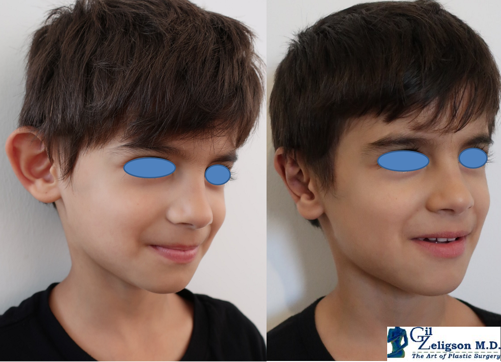 Dr. Gil Zeligson - Otoplasty