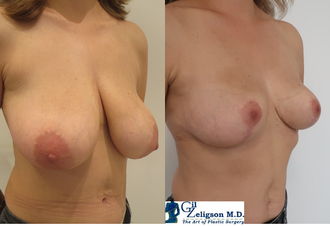 Dr. Gil Zeligson - Breast Reduction