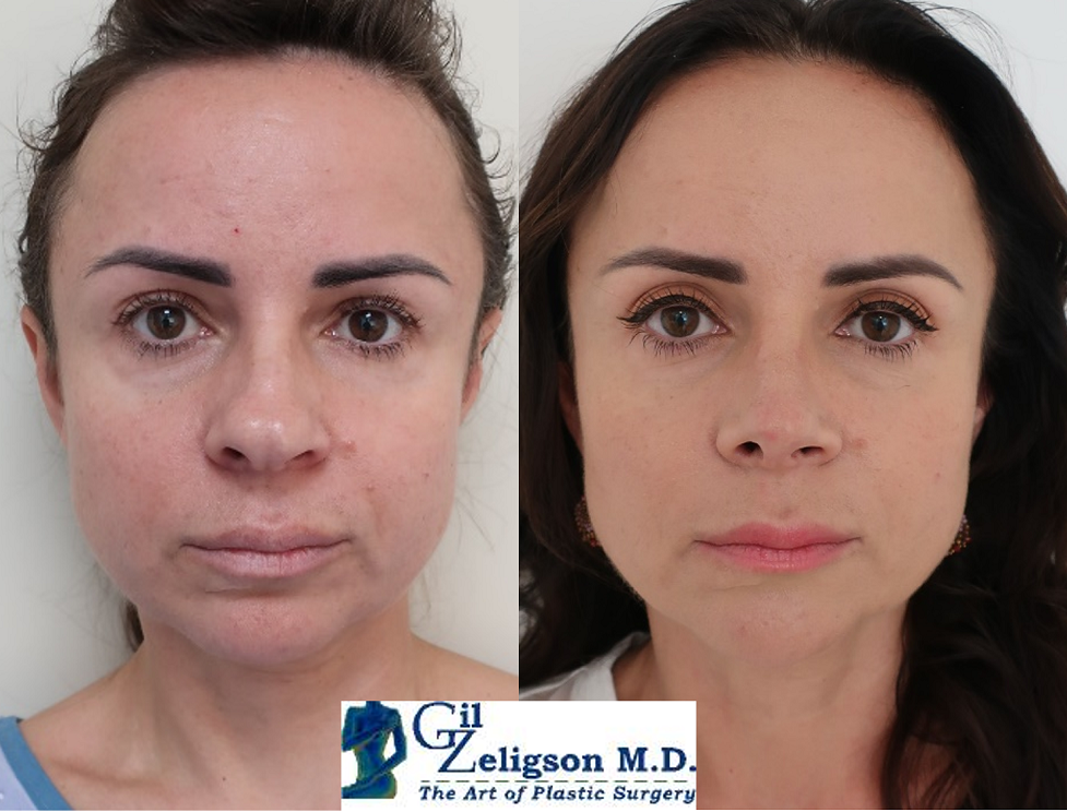 Dr. Gil Zeligson - Rhinoplasty