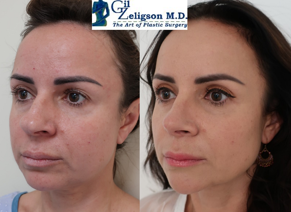 Dr. Gil Zeligson - Facial Sculpturing Hyaluronic acid