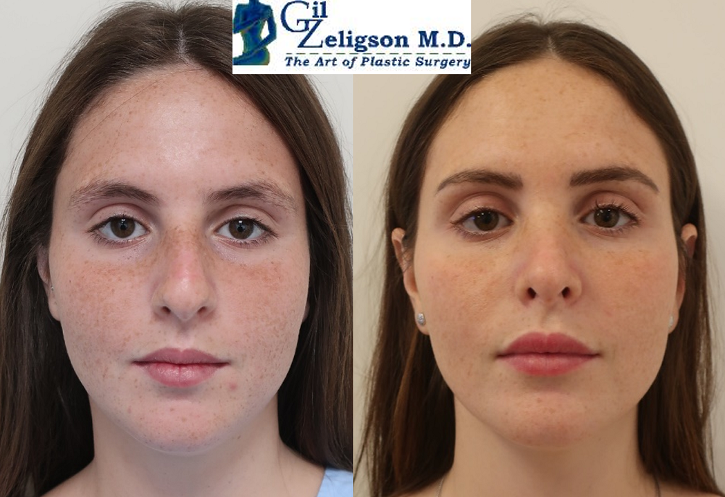 Dr. Gil Zeligson - Rhinoplasty