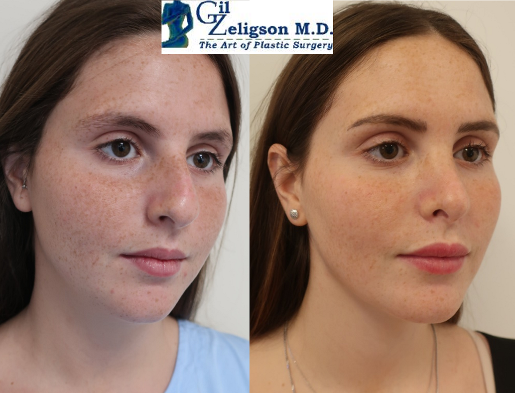Dr. Gil Zeligson - Rhinoplasty