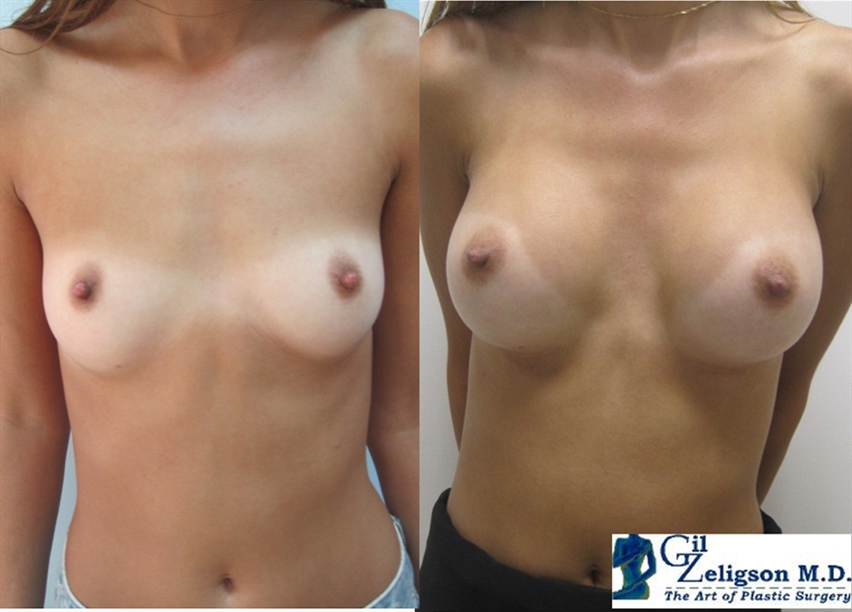 Dr. Gil Zeligson - Breast augmentation