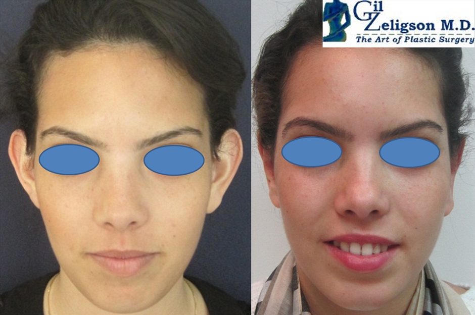 Dr. Gil Zeligson - Otoplasty