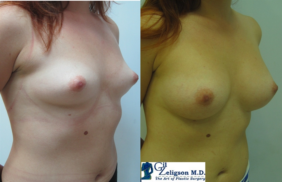 Dr. Gil Zeligson - Breast augmentation
