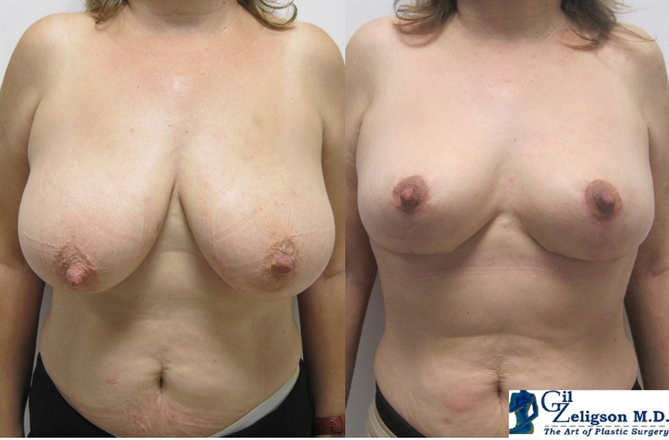 Dr. Gil Zeligson - Breast Reduction