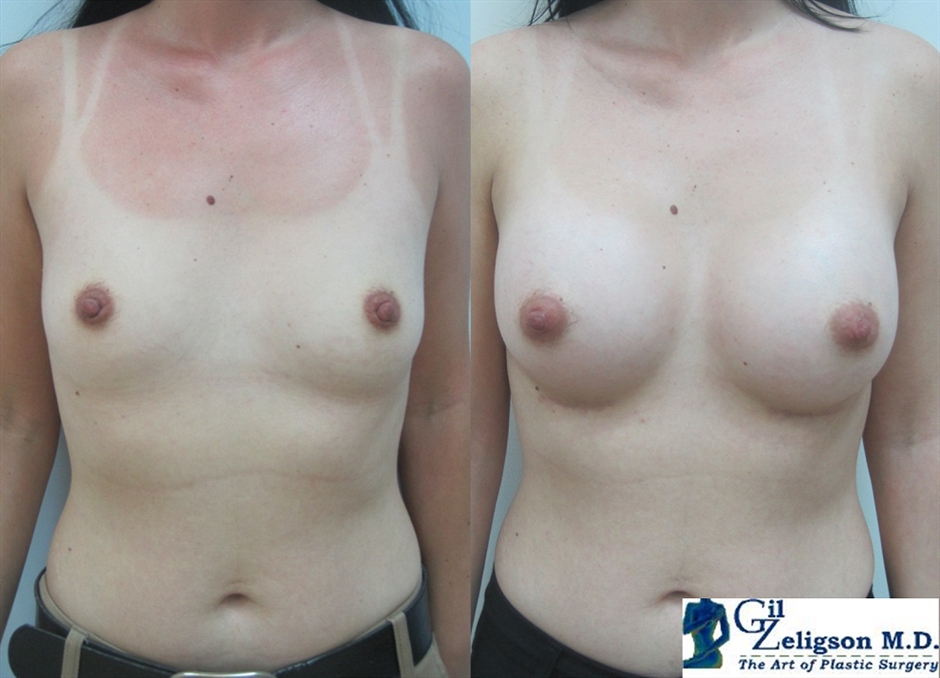 Dr. Gil Zeligson - Breast augmentation