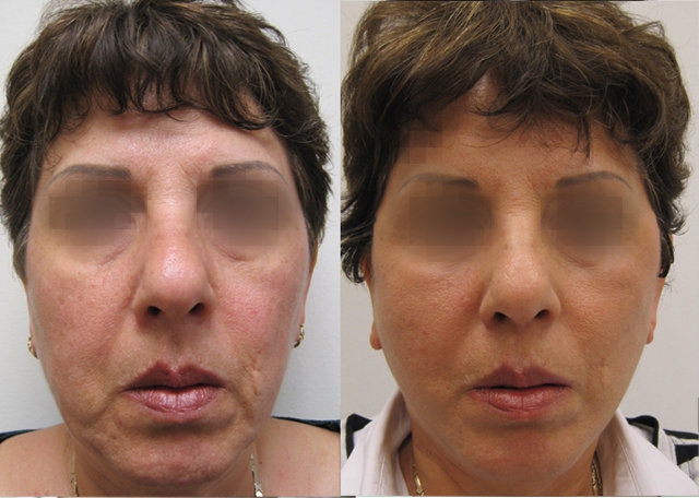 Dr. Gil Zeligson - Facelift