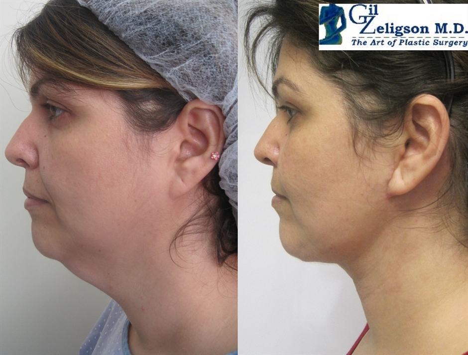 Dr. Gil Zeligson - Facelift