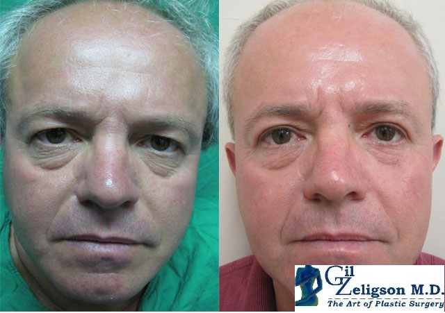 Dr. Gil Zeligson - Upper and Lower Eyelids