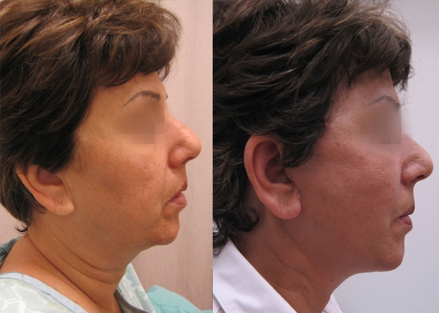 Dr. Gil Zeligson - Facelift