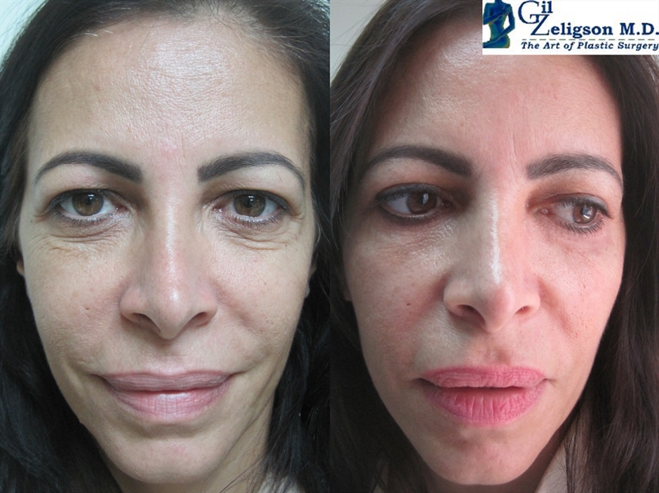 Dr. Gil Zeligson - Upper and Lower Eyelids