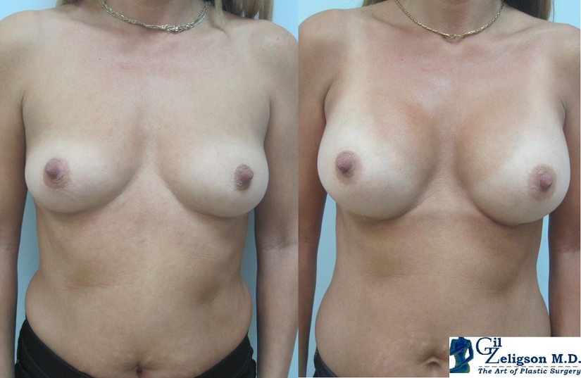 Dr. Gil Zeligson - Breast augmentation