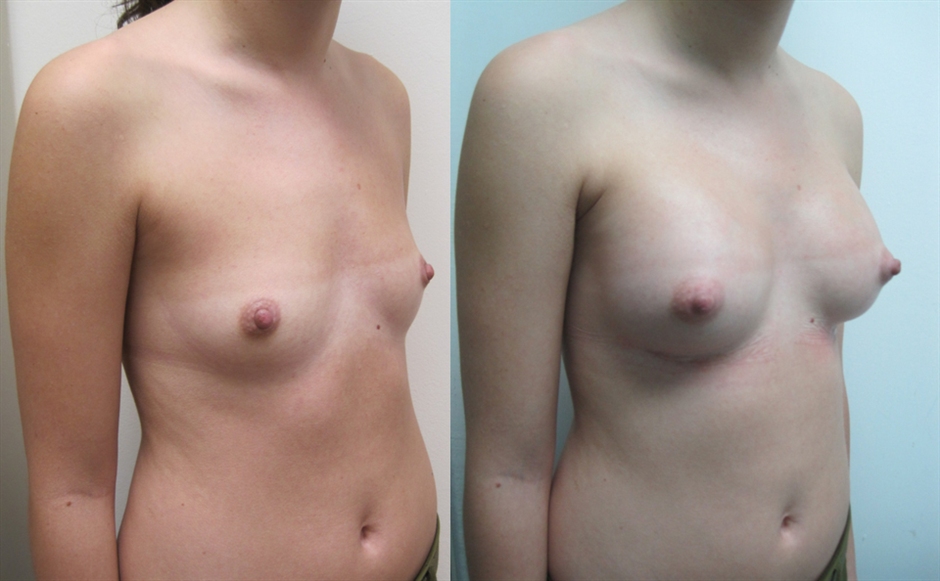 Dr. Gil Zeligson - Breast augmentation