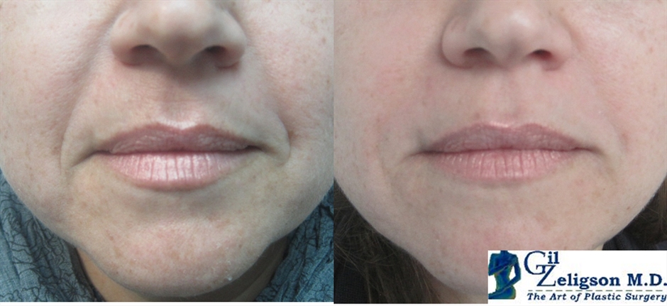Dr. Gil Zeligson - Lips augmentaion & Wrinkles filling