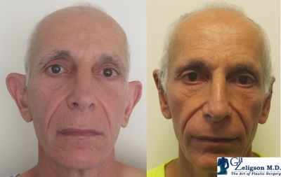Dr. Gil Zeligson - Otoplasty