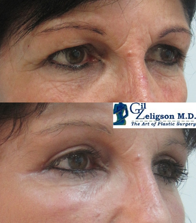 Dr. Gil Zeligson - Upper and Lower Eyelids