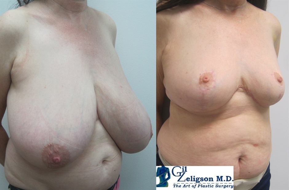 Dr. Gil Zeligson - Breast Reduction