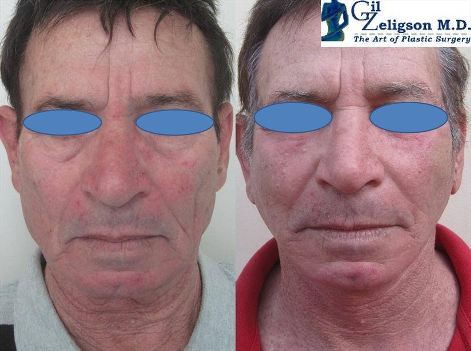 Dr. Gil Zeligson - Facelift