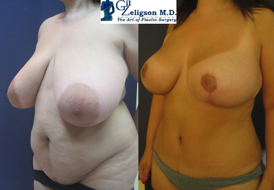 Dr. Gil Zeligson - Breast Reduction