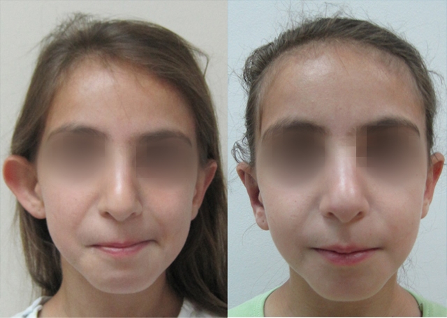 Dr. Gil Zeligson - Otoplasty