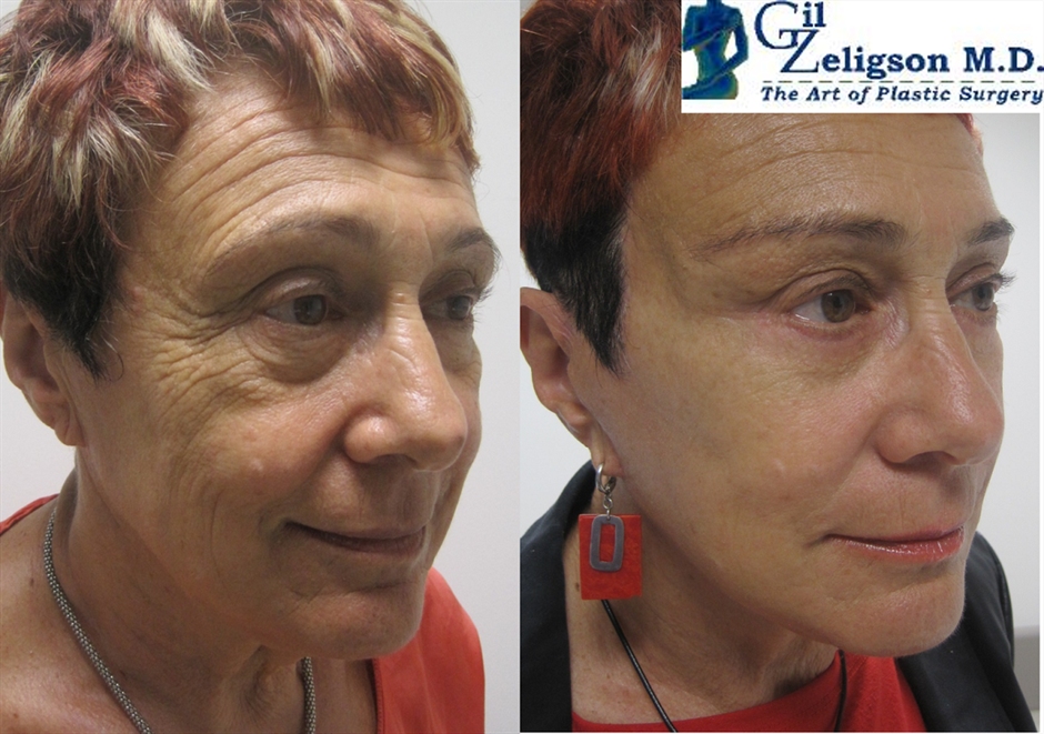 Dr. Gil Zeligson - Facelift