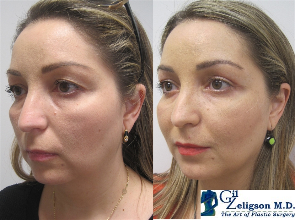 Upper and Lower Eyelids