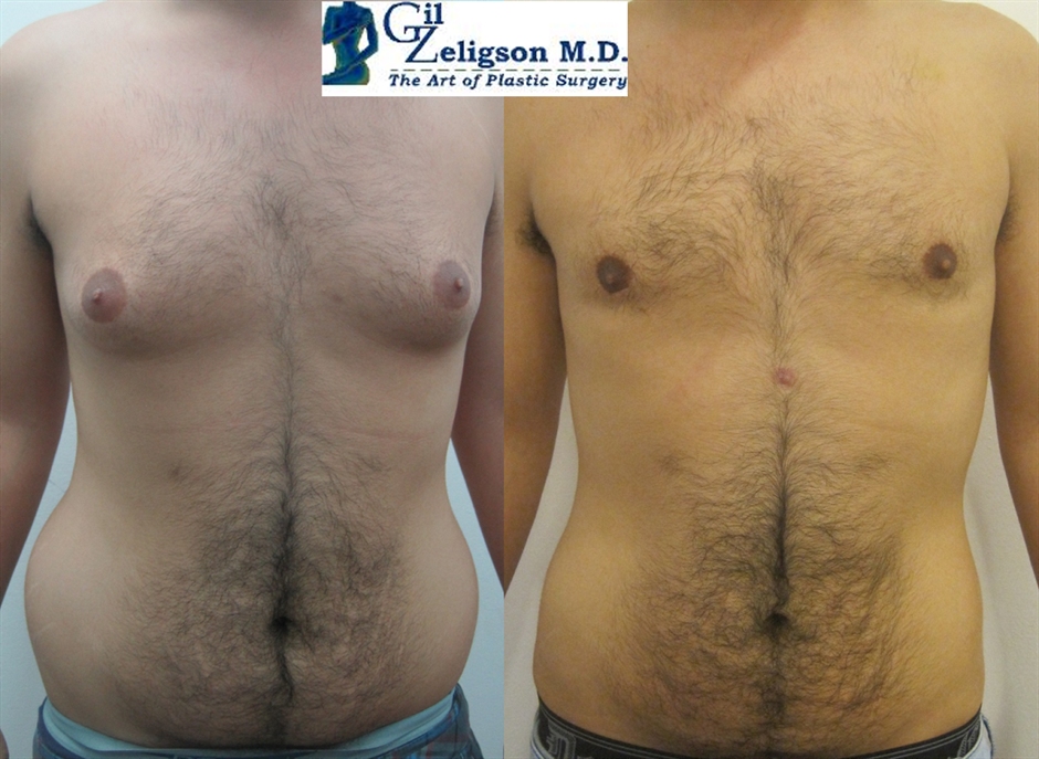 Dr. Gil Zeligson - Gynecomasty