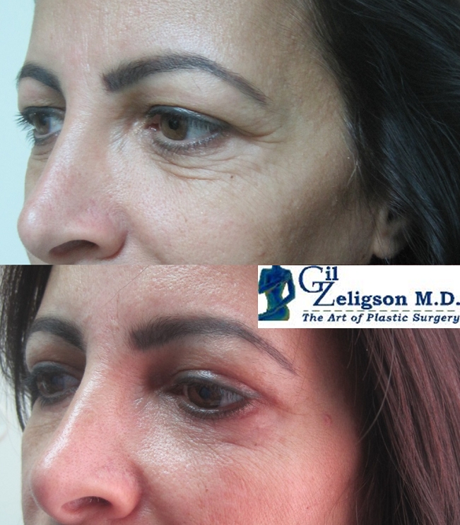 Dr. Gil Zeligson - Upper and Lower Eyelids