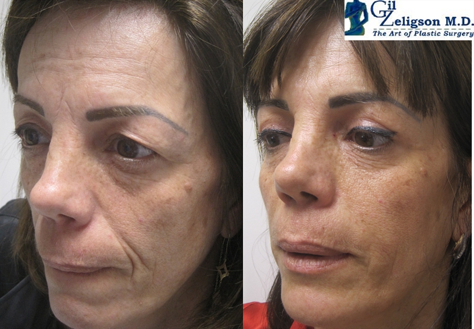 Dr. Gil Zeligson - Upper and Lower Eyelids