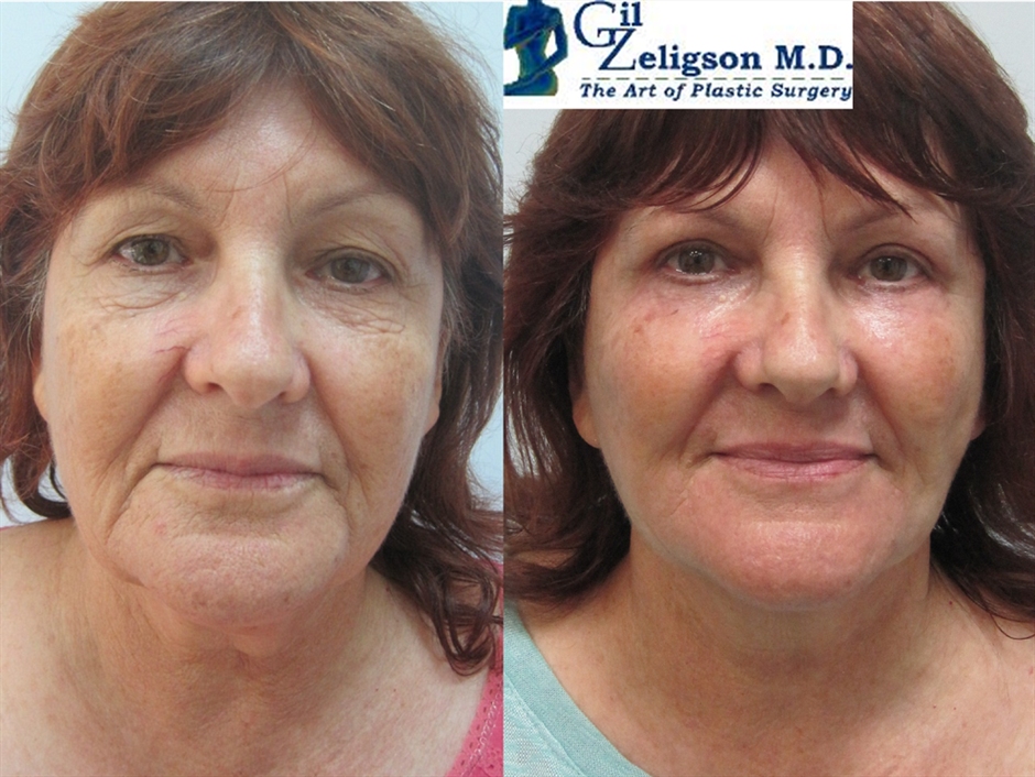 Dr. Gil Zeligson - Upper and Lower Eyelids