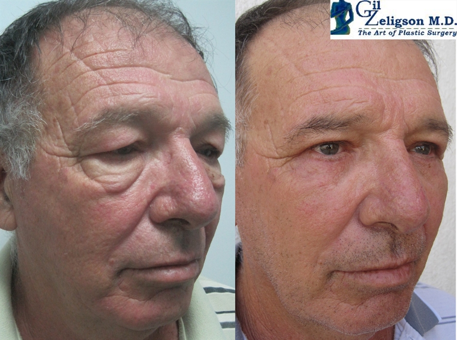 Dr. Gil Zeligson - Upper and Lower Eyelids
