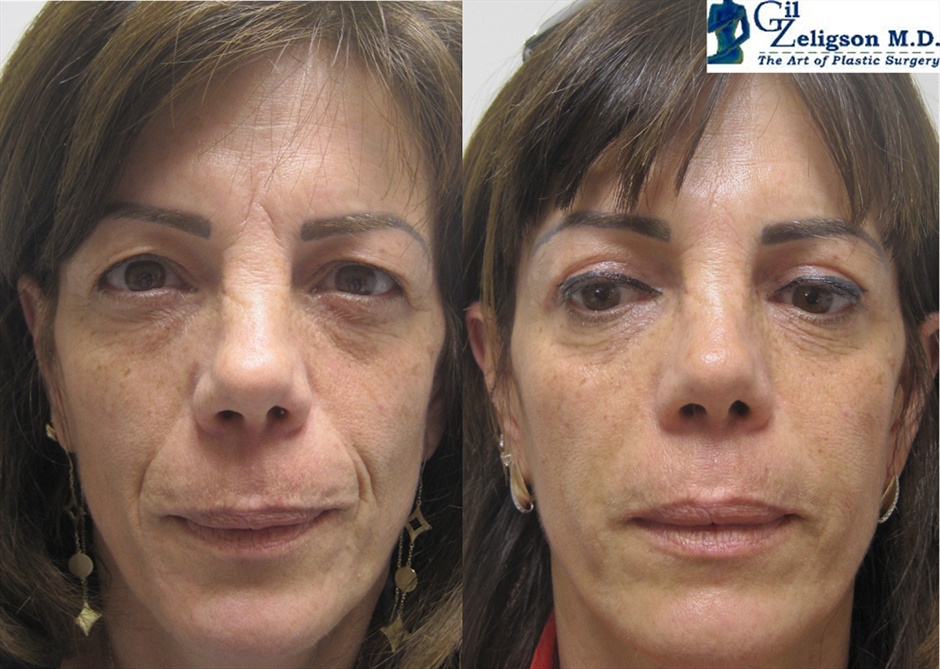 Dr. Gil Zeligson - Lips augmentaion & Wrinkles filling