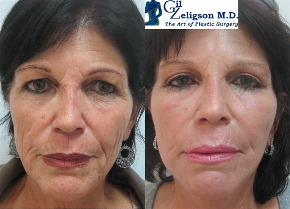 Dr. Gil Zeligson - Upper and Lower Eyelids