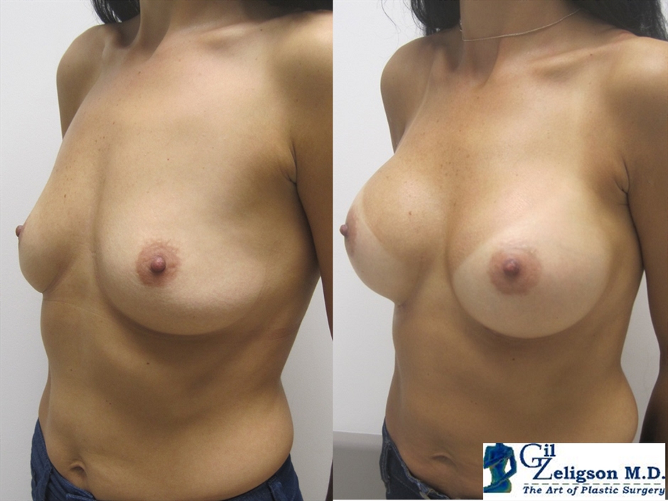Dr. Gil Zeligson - Breast augmentation