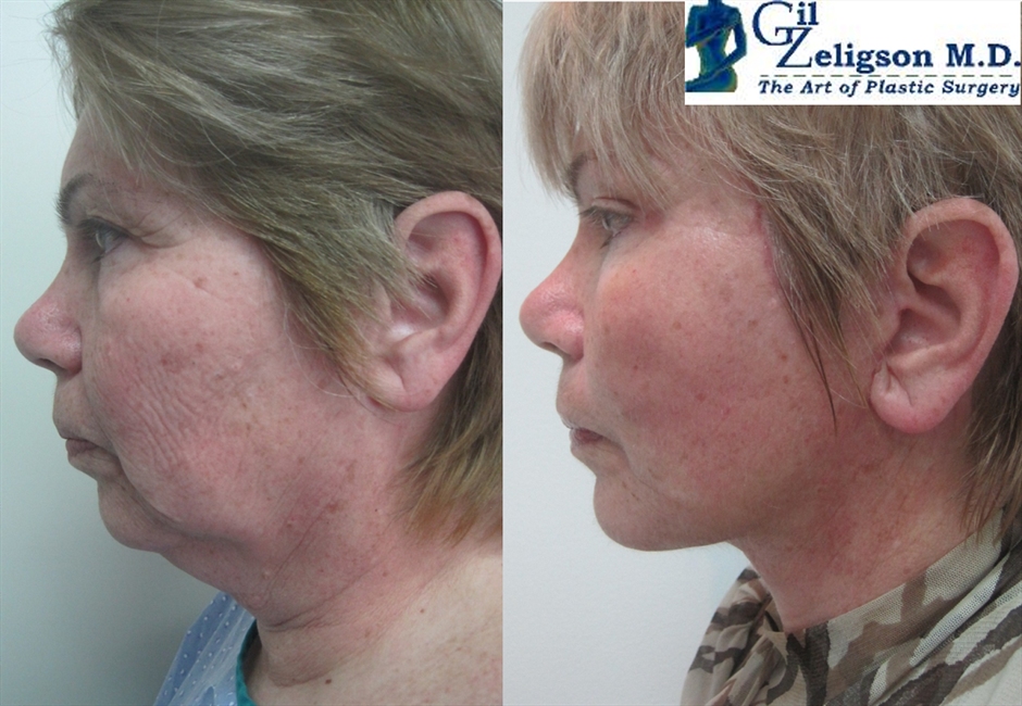 Dr. Gil Zeligson - Facelift