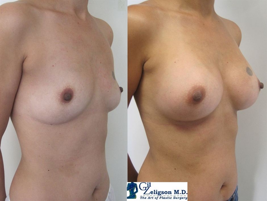 Dr. Gil Zeligson - Breast augmentation