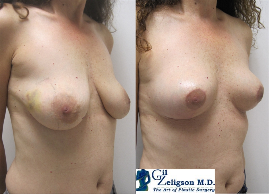 Dr. Gil Zeligson - Breast Reduction