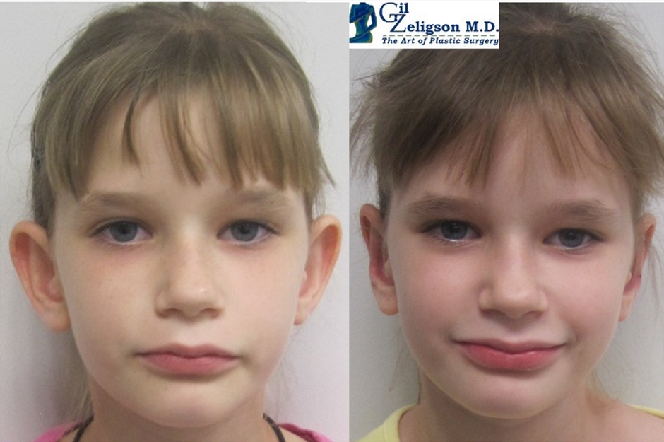 Dr. Gil Zeligson - Otoplasty