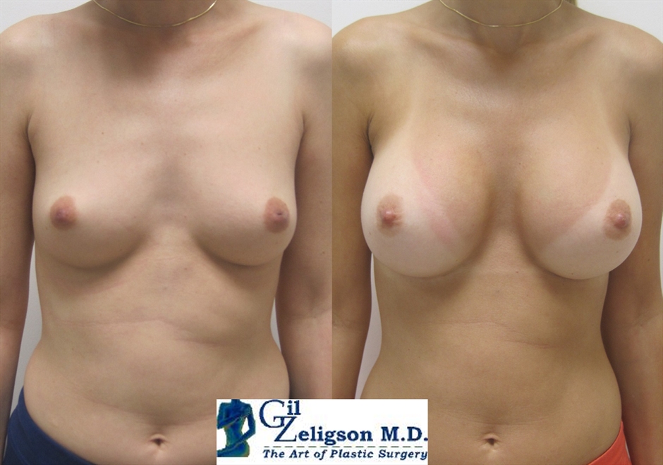 Dr. Gil Zeligson - Breast augmentation