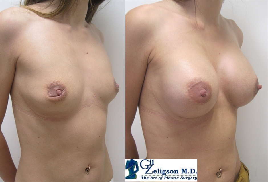Dr. Gil Zeligson - Breast augmentation